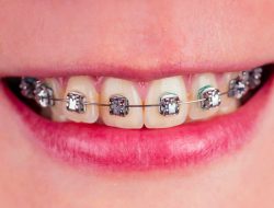 macro shot of white teeth with braces with green color spot
